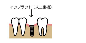 インプラントの埋込手術