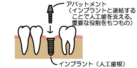 安定期間後の二次処置