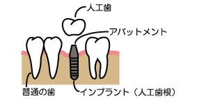 人工歯の作成、装着