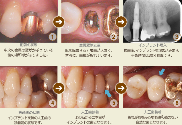 インプラント一本の治療例