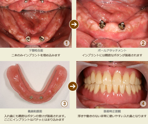 インプラントにより入れ歯を安定させた治療例