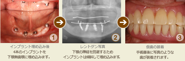 入れ歯からインプラントに切り替えた治療例（オールオンフォー）