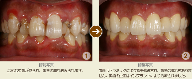 審美治療とインプラントの治療例