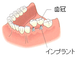 インプラント